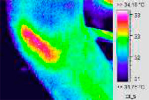 Epicondylitis - Rot im Wärmebild